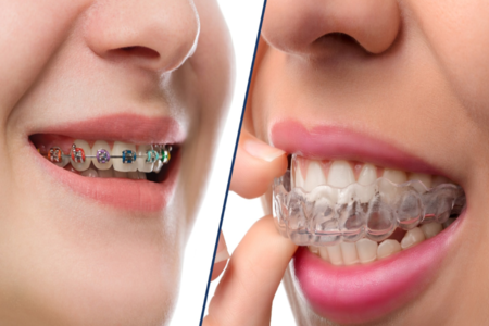 Braces & Clear Aligners